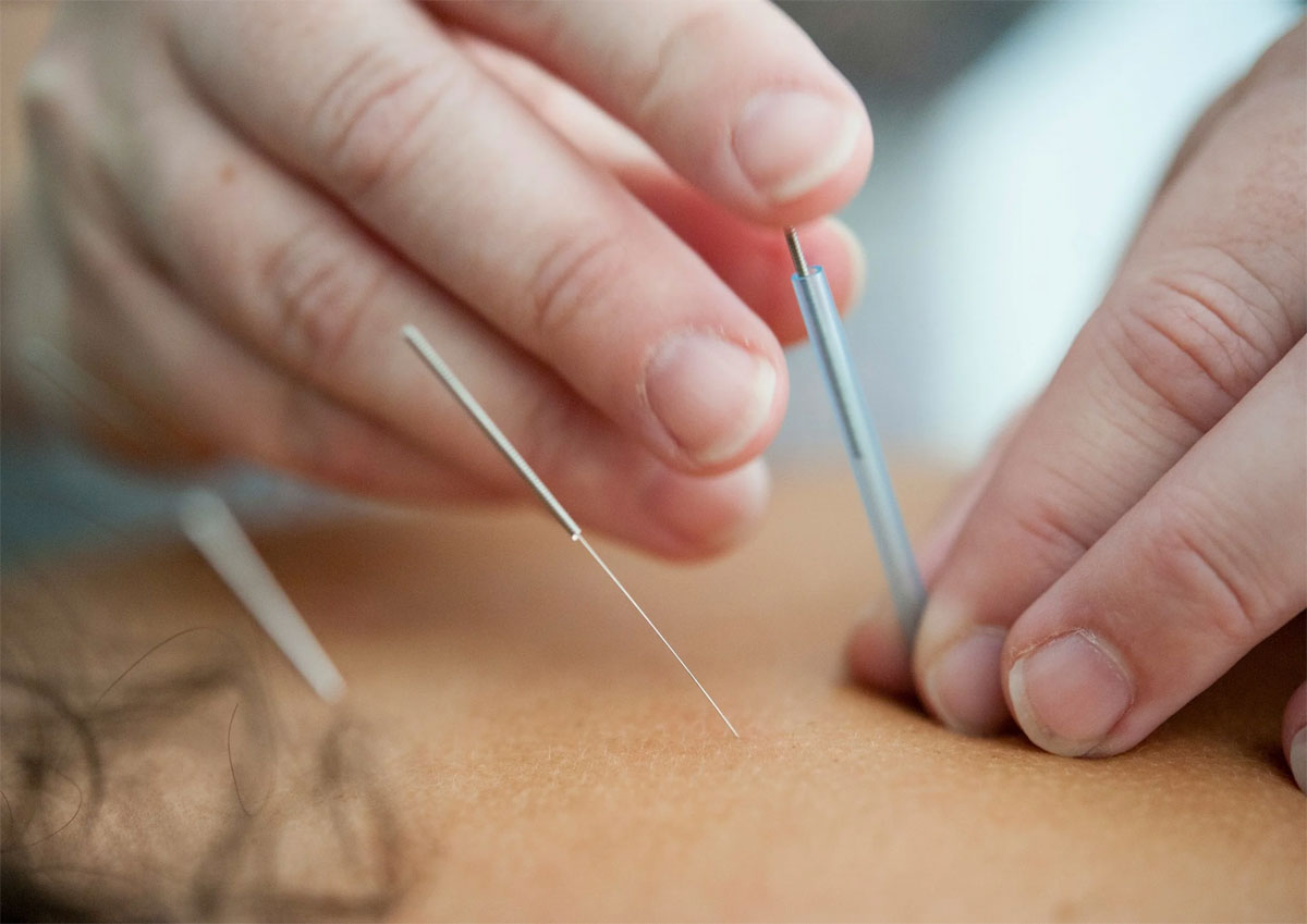 Best Acupuncture treatment in Hyderabad for pain relief and stress