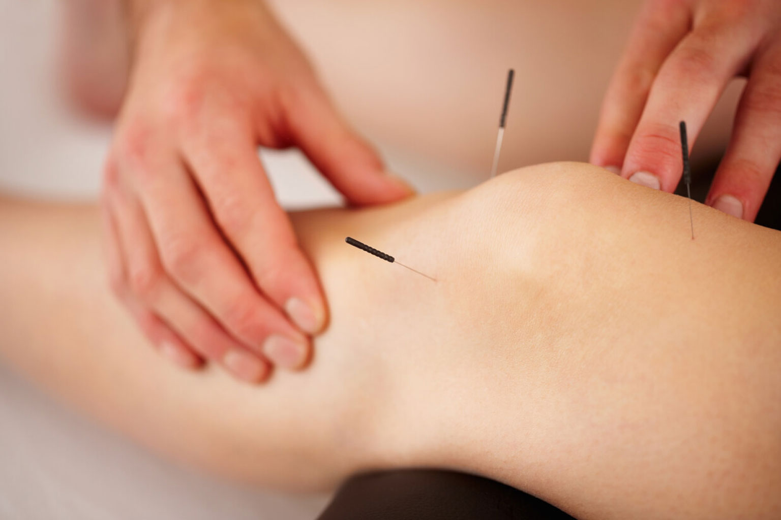 Best acupuncture treatment for joint pain Hyderabad