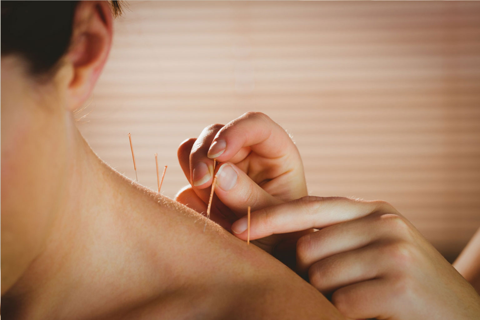 Best acupuncture treatment for stress Hyderabad
